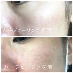 新メニュー‼︎ ハーブピーリングついにスタート‼︎