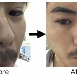 お肌にお悩みのある方へ(吹き出物、ニキビ、黒ずみetc…)